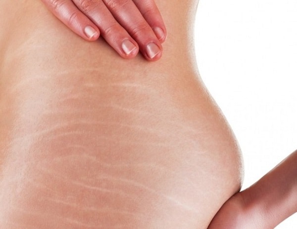 óleo essencial estria gravidez gestação pele rosa alecrim